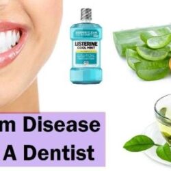 How to Conquer Gum Disease: A Guide to Healing Your Gums Naturally