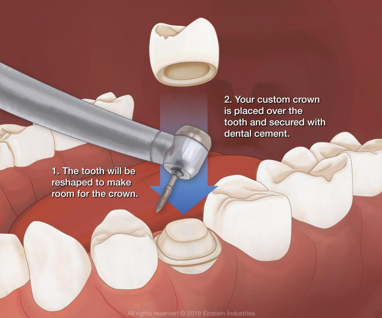 How to Care for Dental Crowns, A Comprehensive Guide to Maintain a Healthy Smile